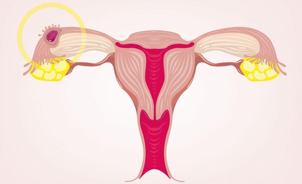 ectopic pregnancy