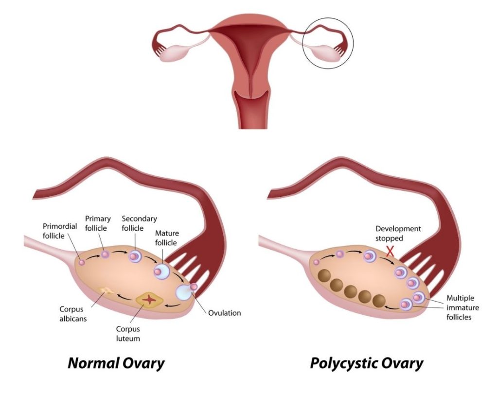 PCOS and Pregnancy: Fertility, Gestation, Postpartum