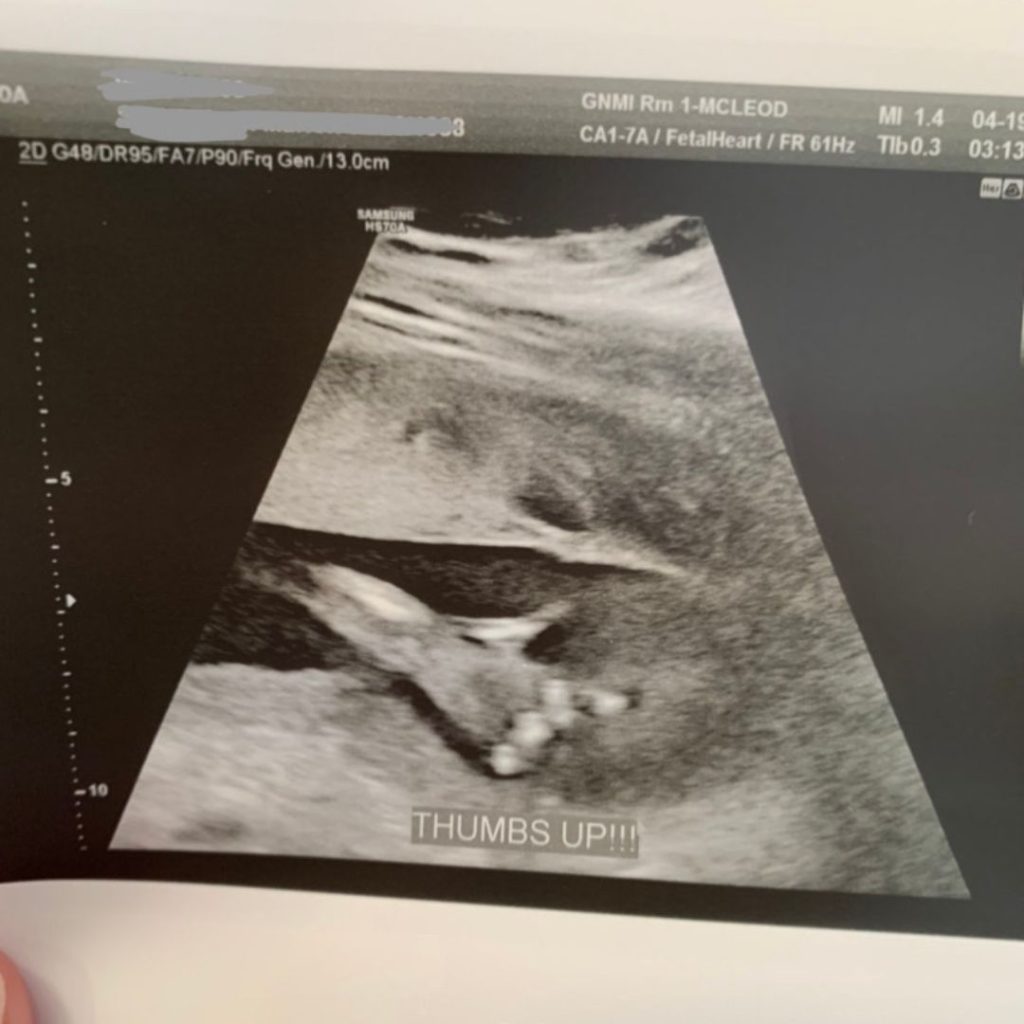 Ultrasound thumbs up