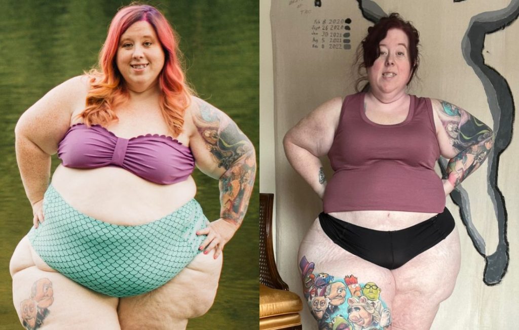 Lipedema Surgery Before And After Story - Cara's Fight For Care